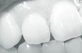 Problemen met tanden fineer