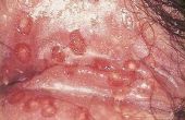 Symptomen van herpes cyste