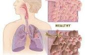 Is COPD erfelijk?