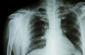 Tekenen en symptomen van tuberculose bij volwassenen