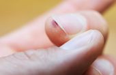 How to Get Rid van gemeenschappelijke wratten onder de nagels