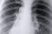 Tekenen & symptomen van gasdruk in de borst