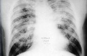 Wat Is longfibrose?