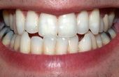 Problemen met tand implantaten