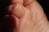 Tekenen & symptomen van artritis in voeten