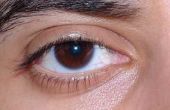 How to Get Rid van een bloeddoorlopen ogen veroorzaakt van een Hit
