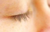 Symptomen van contactdermatitis op oogleden