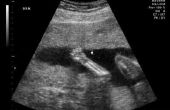 Nauwkeurigheid van een echografie voorspellen gewicht van een Baby
