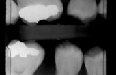 Wat zijn de oorzaken producten voor tandvulling te kwetsen?