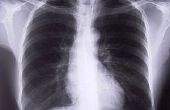 Hoe weet u of u hebt Bronchitis