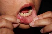 Hoe te behandelen koorts blaren in de mond