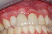 Over mislukte tandheelkundige implantaten