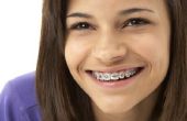 Hoeveel accolades voor tanden kosten doen?
