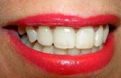 Wat zijn tandheelkundige Lumineers?