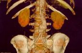 Symptomen van een gescheurde abdominale aorta aneurysma