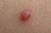 HPV symptomen op de huid
